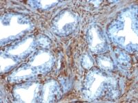 FFPE human prostate carcinoma sections stained with 100 ul anti-Galectin-1 (clone GAL1/1831) at 1:100. HIER epitope retrieval prior to staining was performed in 10mM Citrate, pH 6.0.